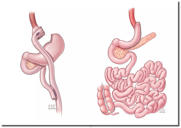 bariatric surgery-graphic