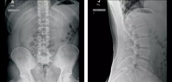 For Active Patients with Spondylolysis or Spondylolisthesis, Pain Control  Guides Return to Sports