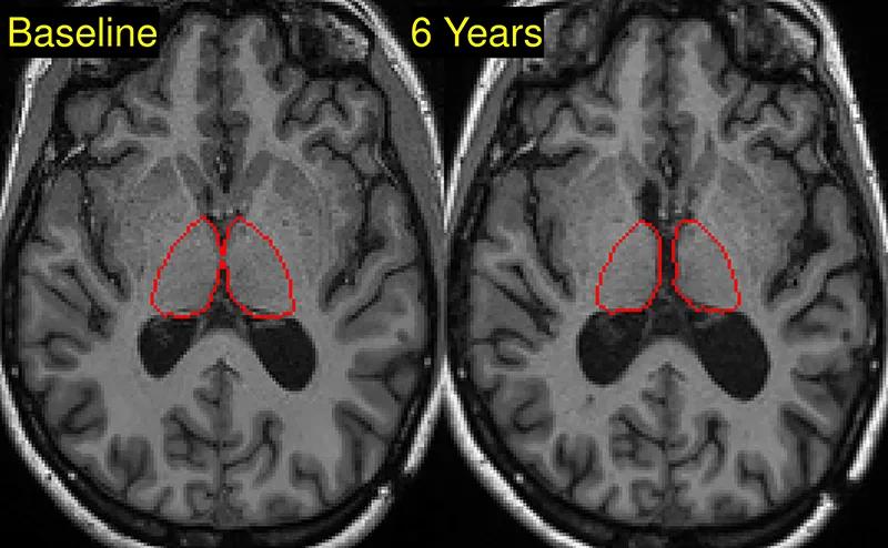 two brain MRIs side by side with red circles on them