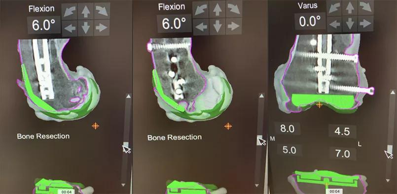 Computer model helping plan implant