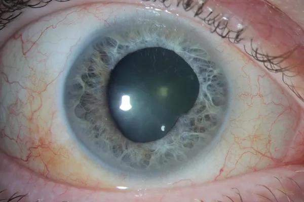  Four weeks after the anterior chamber washout.