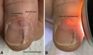 Subungual digital mucous cyst of the thumbnail