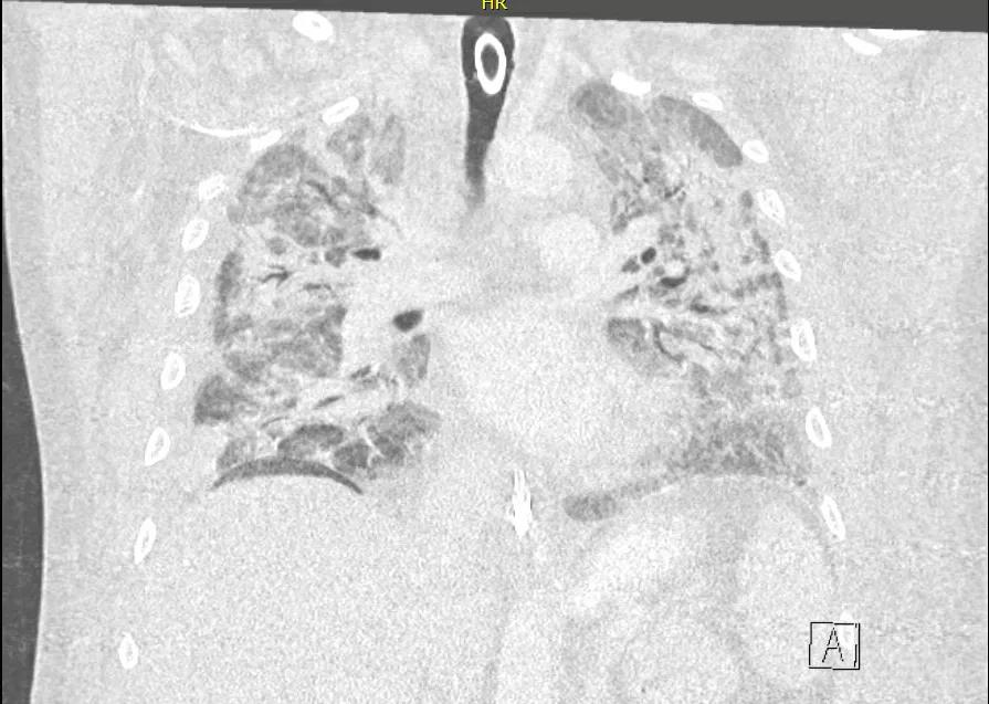 Chest CT