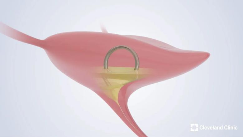 Image showing device inserted into the bladder