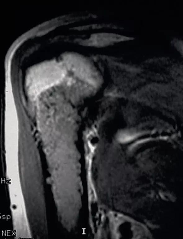 Figure 4. Coronal T1-weighted MRI showing chondrosarcoma with marked scalloping of cortex