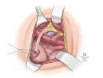 H. Ureteral anastomosis over stent