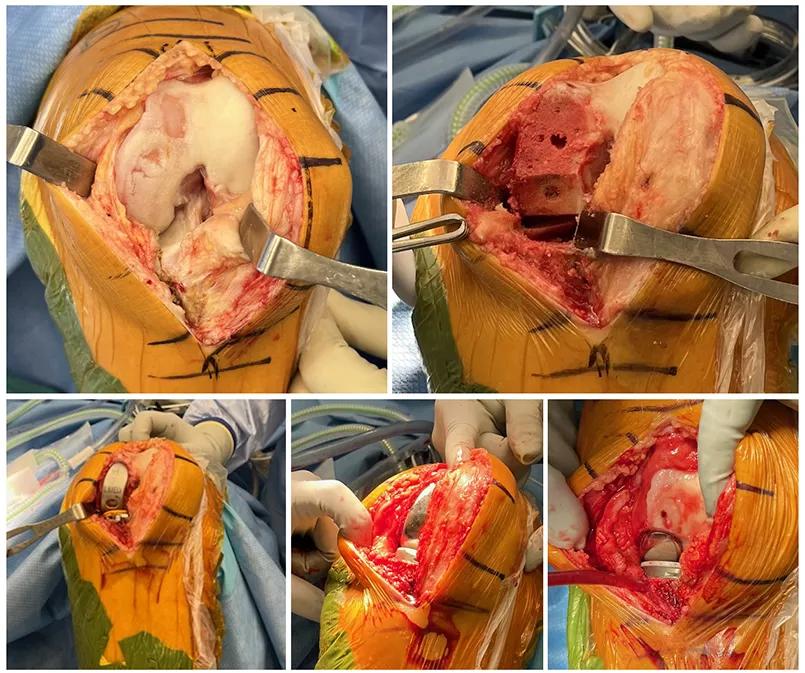 Surgical photos of unicompartmental knee arthroplasty