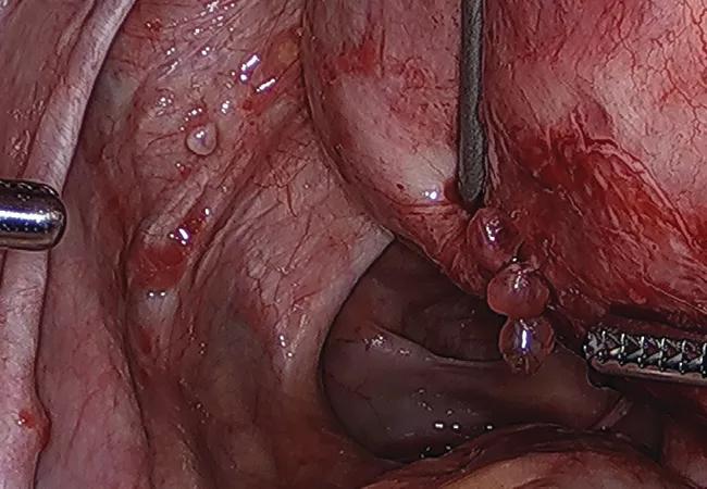 Papillary lesions 