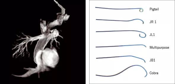 Three-dimensional rotational angiography following a fenestrated extracardiac Fontan procedure.