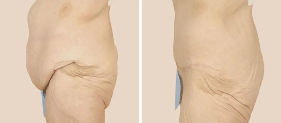Before tummy tuck (left) and 13 months after tummy tuck (right).