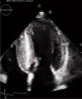 LV Strain May Offer Independent Prognostic Utility in Obstructive Hypertrophic Cardiomyopathy