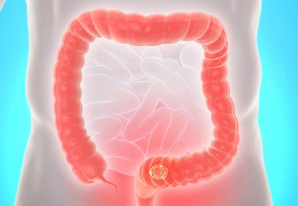 3d illustration of colorectal cancer in the human male