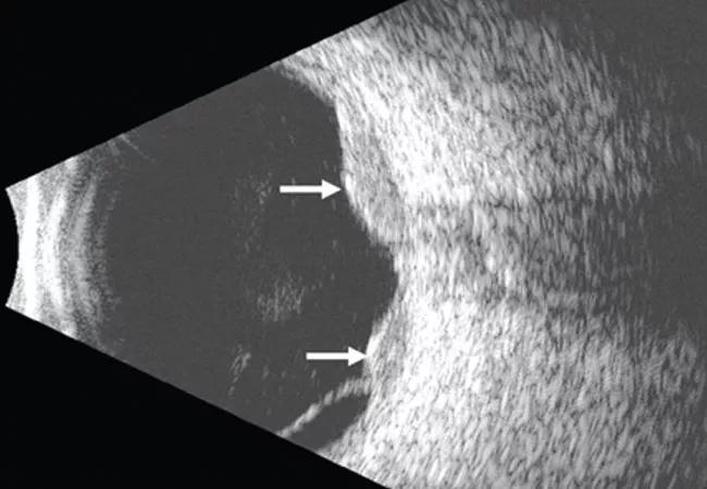 Ultrasonography of the left eye confirmed the choroidal location of the lesions noted on fundoscupy.