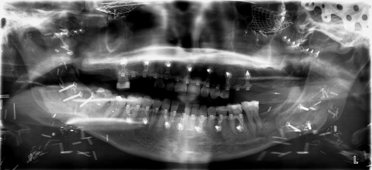  When her transplant was eventually performed, Katie received both the donor’s maxilla and mandible. 