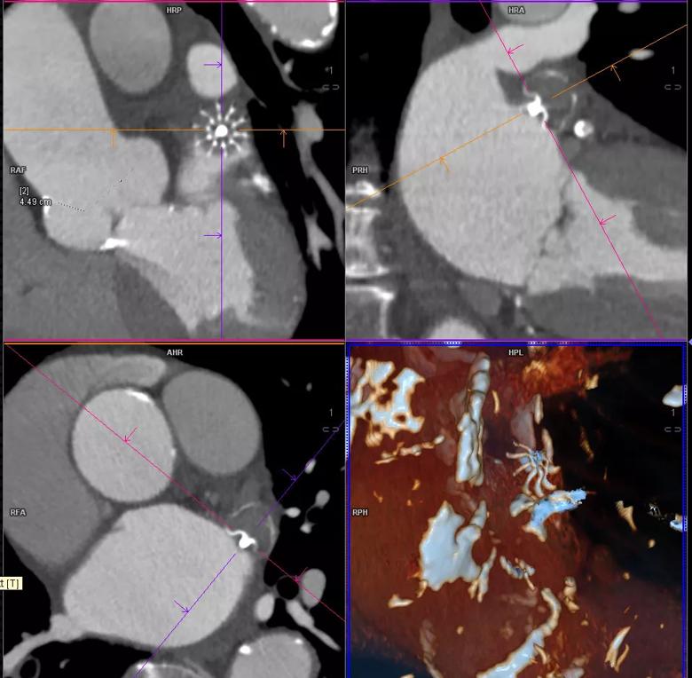 CT images from a patient with prior placement of the Watchman® left atrial appendage (LAA) closure device.