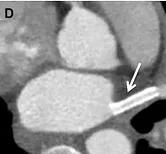 Figure D. Post-procedural chest CT demonstrating patency of the left superior pulmonary vein stent.