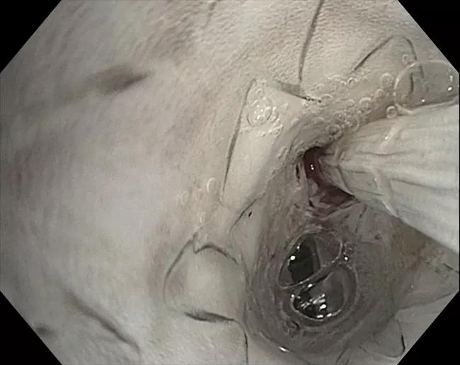 Stent