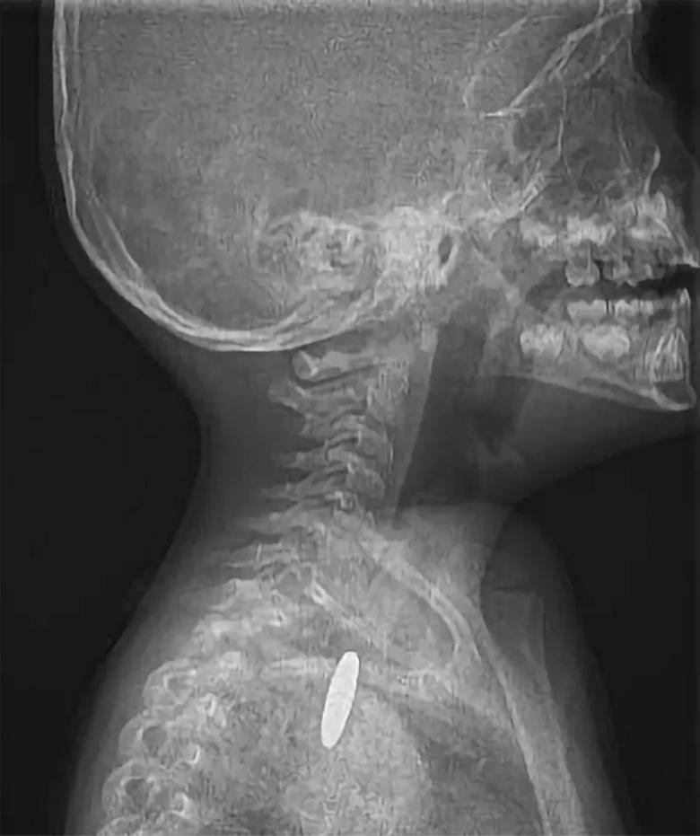 Lateral X-ray showing swallowed coin