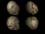 The parietal subdural shunt was removed during cranial vault remodeling.
