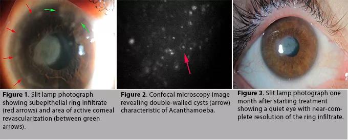 CQD1setContactLense