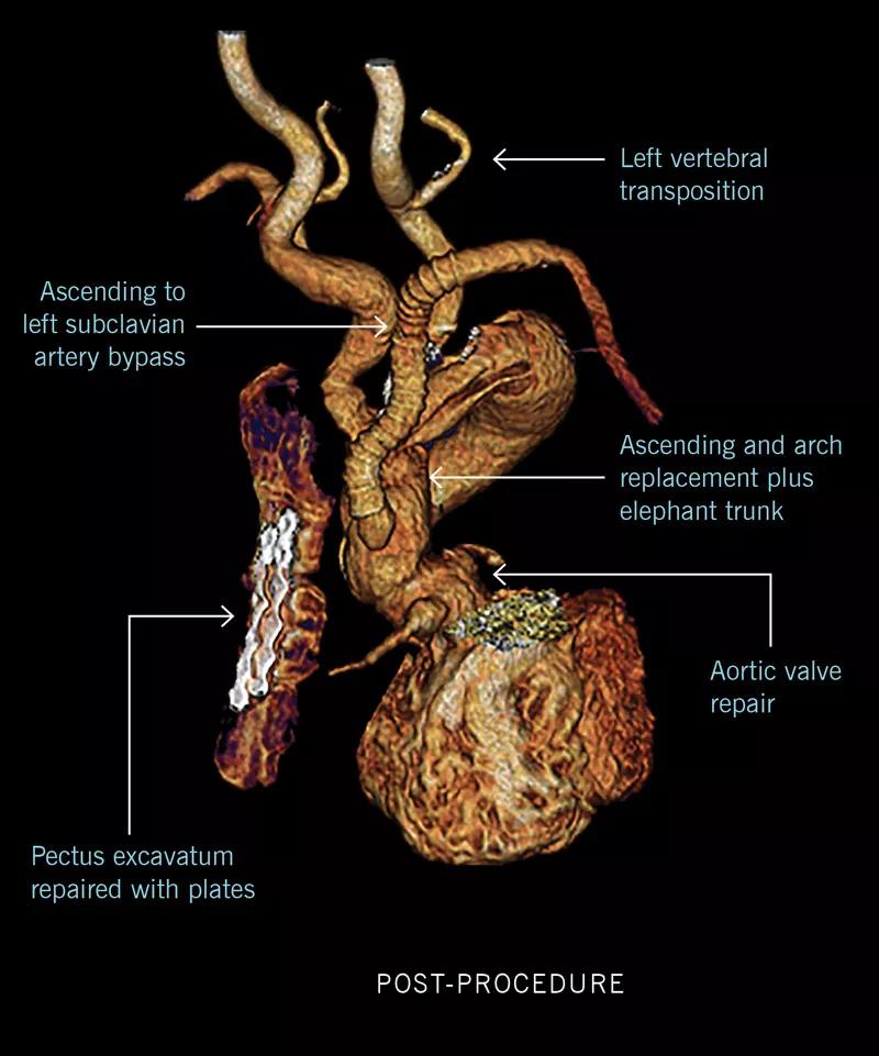 Loeys-Dietz syndrome