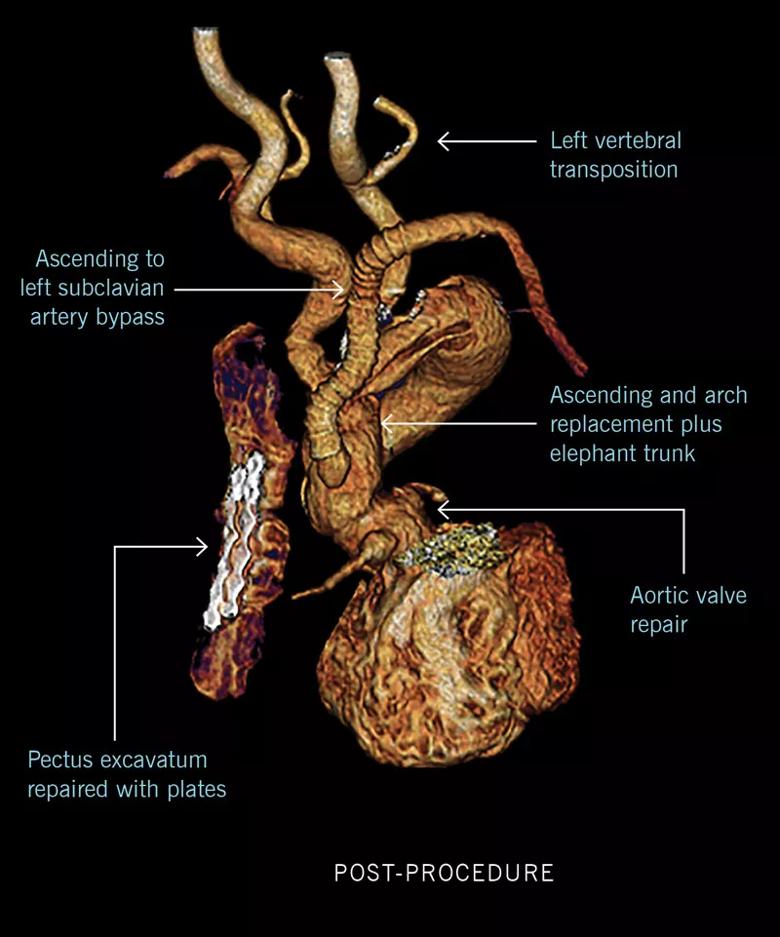 Loeys-Dietz syndrome