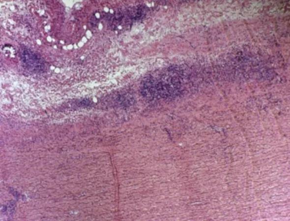 Figure 1. Aortic arch specimen from a patient with an enlarging aneurysm due to a necrotizing inflammatory process (10× magnification, H&E stain).