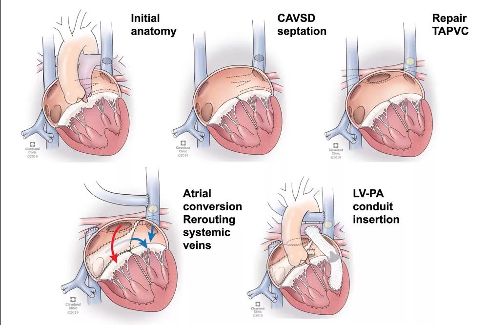 Ventricular switch