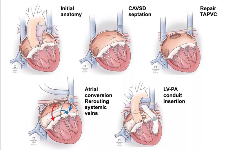 Ventricular switch