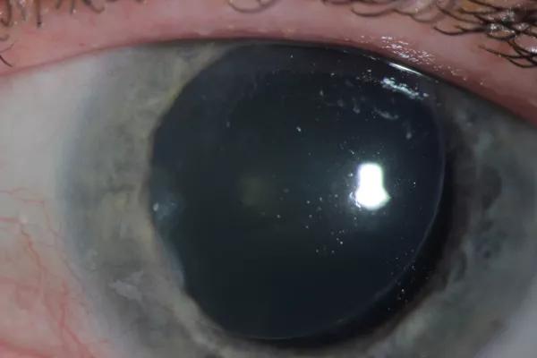 Figure 4: OCT image taken 3 months postoperatively shows attached DSEK graft which is plugging the extremely thin peripheral cornea.