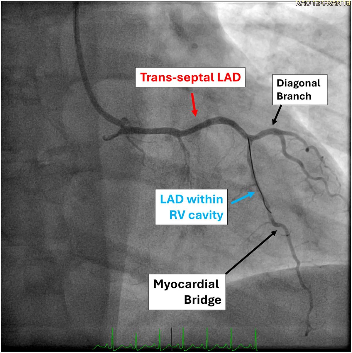 scan of a blood vessel with text label overlays