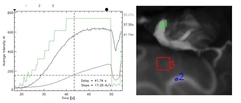 FLOW 800 analysis after application of the clip to the aneurysm neck.