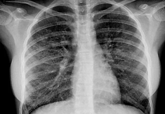 Chest x-ray adolescent vaping injury