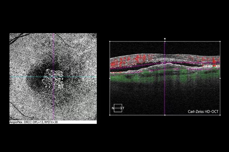 OCT-A revealing choroidal neovascular membrane