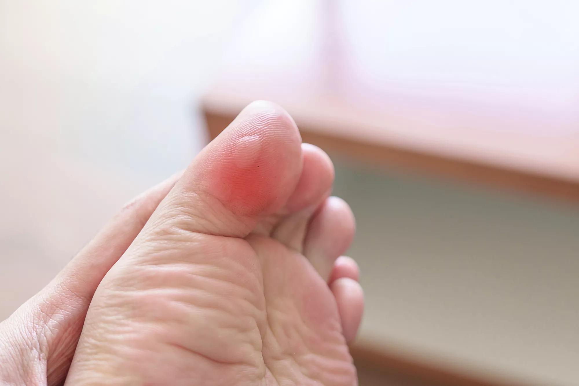 Best Ways to Prevent and Treat Feet Blisters