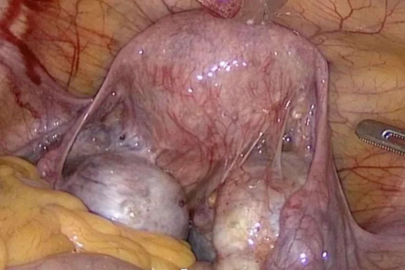 Robotic surgery for gynecological cancers