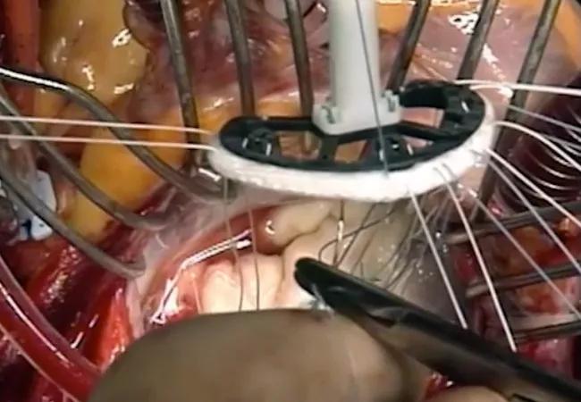 The flexible annuloplasty ring