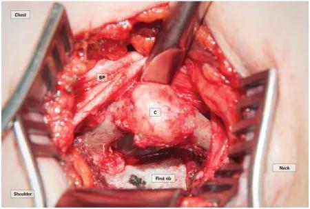 Figure 1. Retraction of the brachial plexus (BP) in the case patient showing the cervical rib (labeled “C”) and articulating joint. Note the first rib more posteriorly.