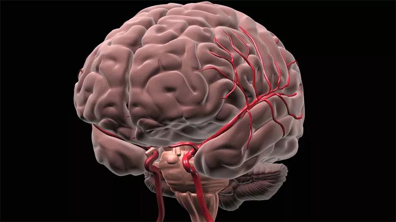 Cleveland-Clinic-Deep-Brain-Bleeds