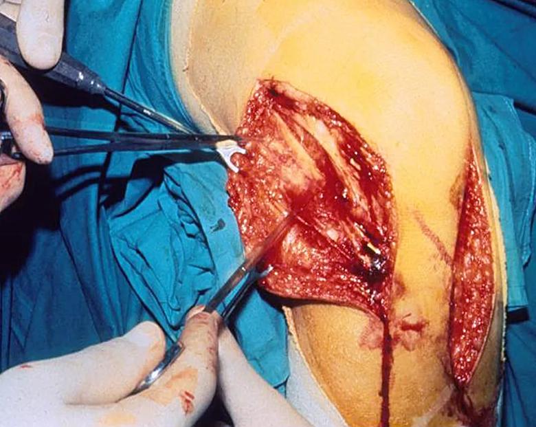 Medial and lateral transfer surgical procedures