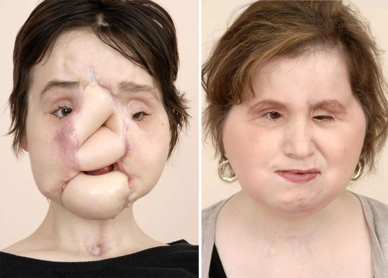 Katie Stubblefield face transplant Cleveland Clinic