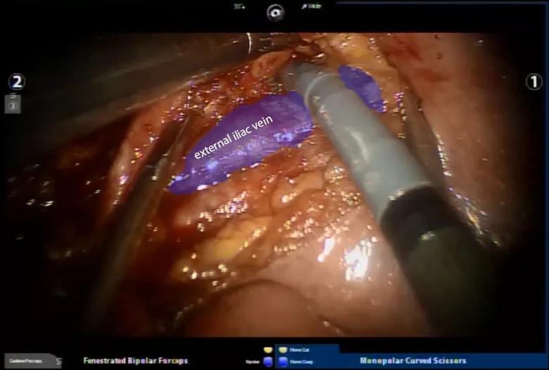 Iliac vein