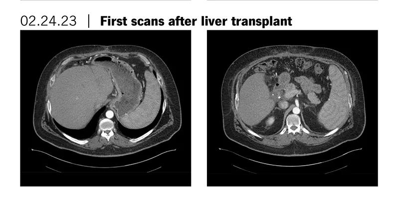 First scan after liver transplant