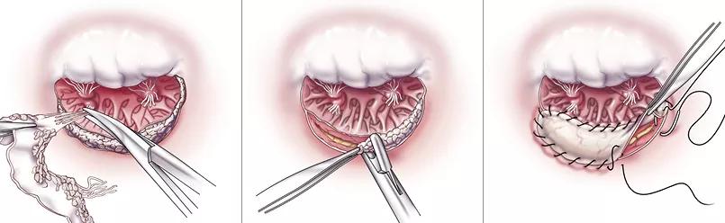illustrations and photos showing key steps surgical treatment of MAC