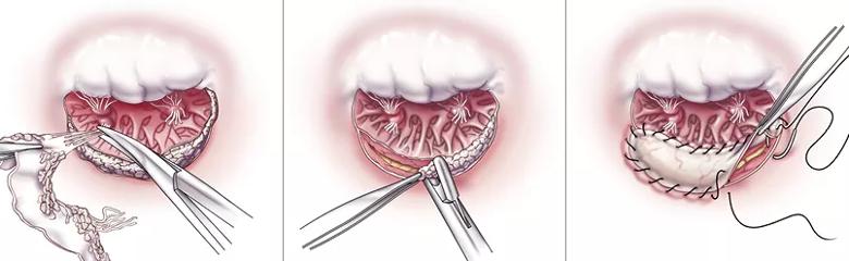 illustrations and photos showing key steps surgical treatment of MAC