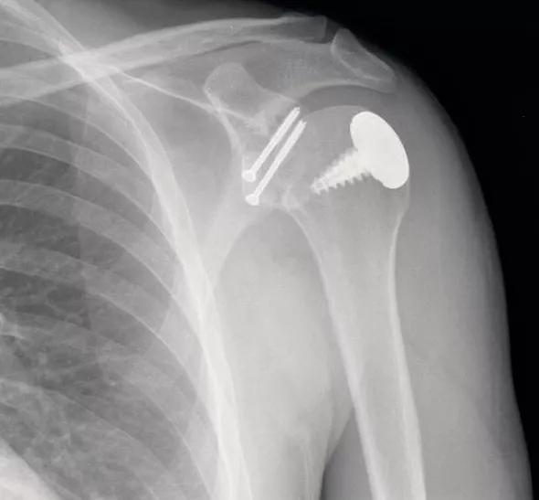 Figure 2. Postoperative radiograph of a patient with recurrent shoulder instability treated with a combined Latarjet procedure and a partial cap resurfacing implant for a Hill-Sachs defect
