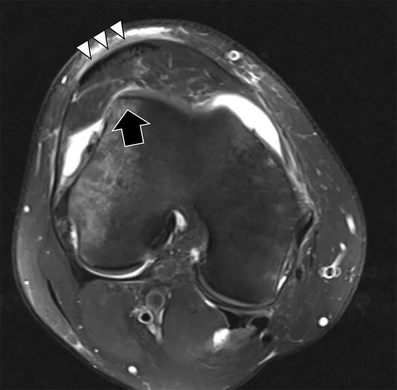 Image of a patellar tendon displaced over the lateral trochlea