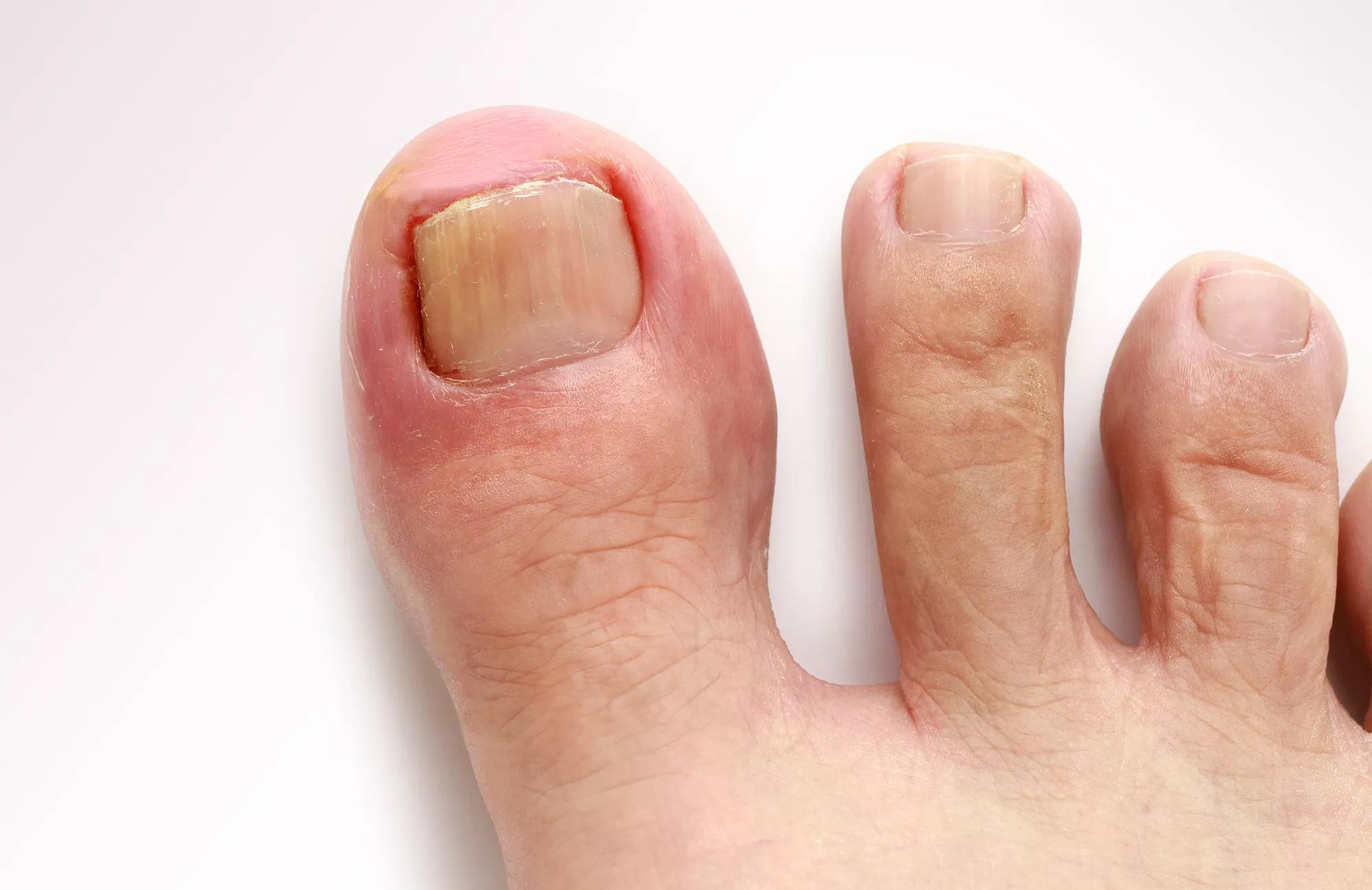 Remedies for Getting Rid of Ingrown Toenails