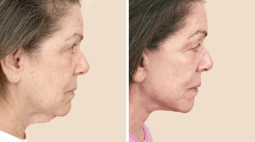 Facelift before & after photo