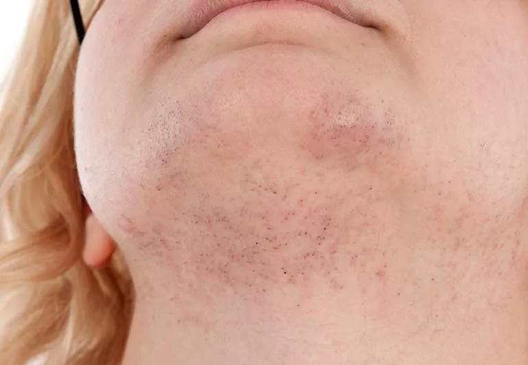 Why Women Get Chin Hair and Treatment Options